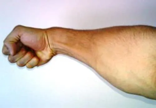 wrist injury